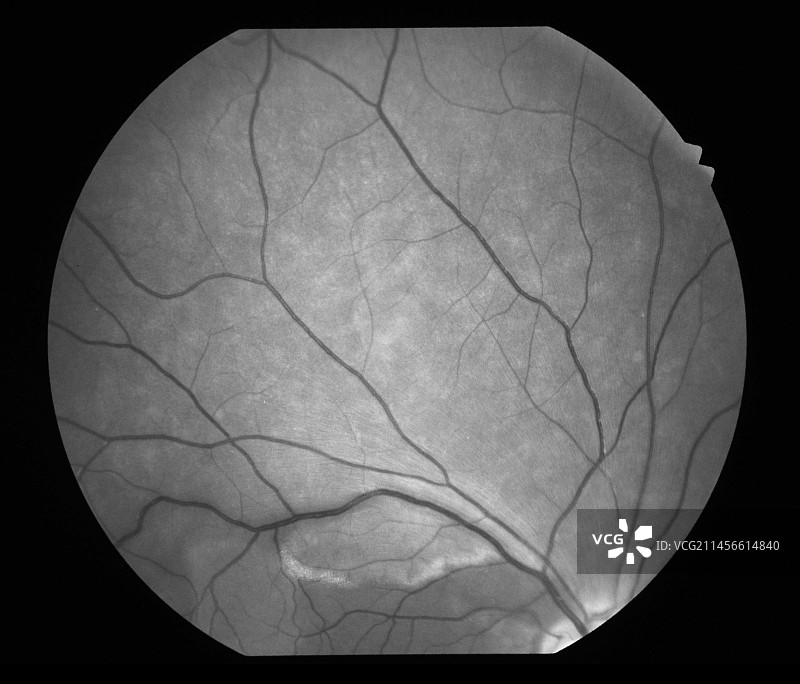 视网膜血管炎，眼底镜检查图片素材