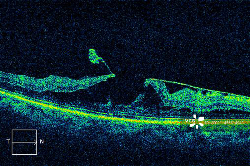 玻璃体黄斑牵引力OCT扫描图片素材