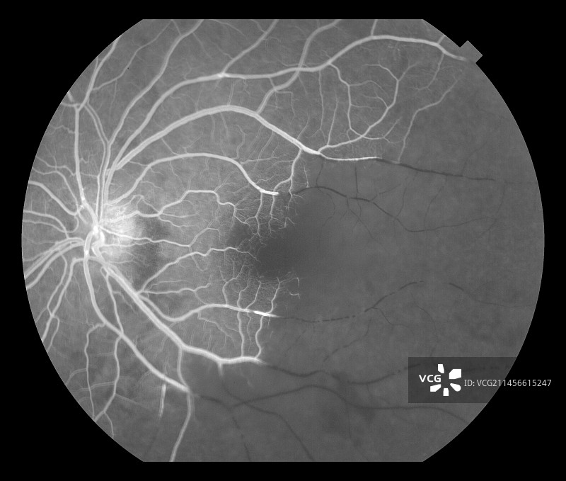 半球视网膜动脉阻塞血管造影图图片素材