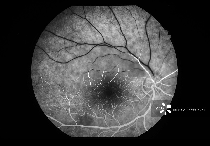 半球视网膜动脉阻塞血管造影图图片素材