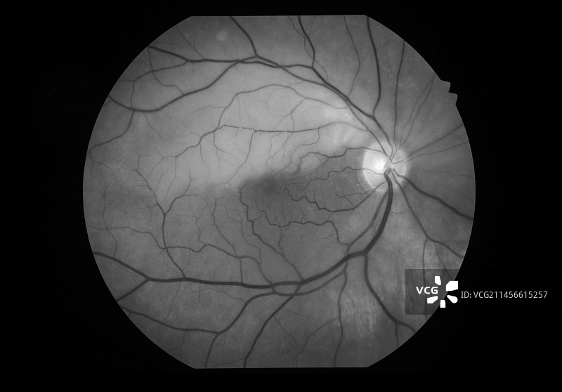 半球形视网膜动脉阻塞眼底镜检查图片素材