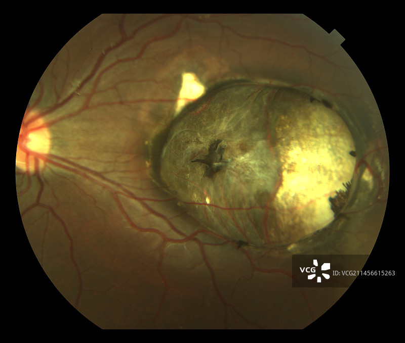 黄斑缺损眼底镜检查图片素材