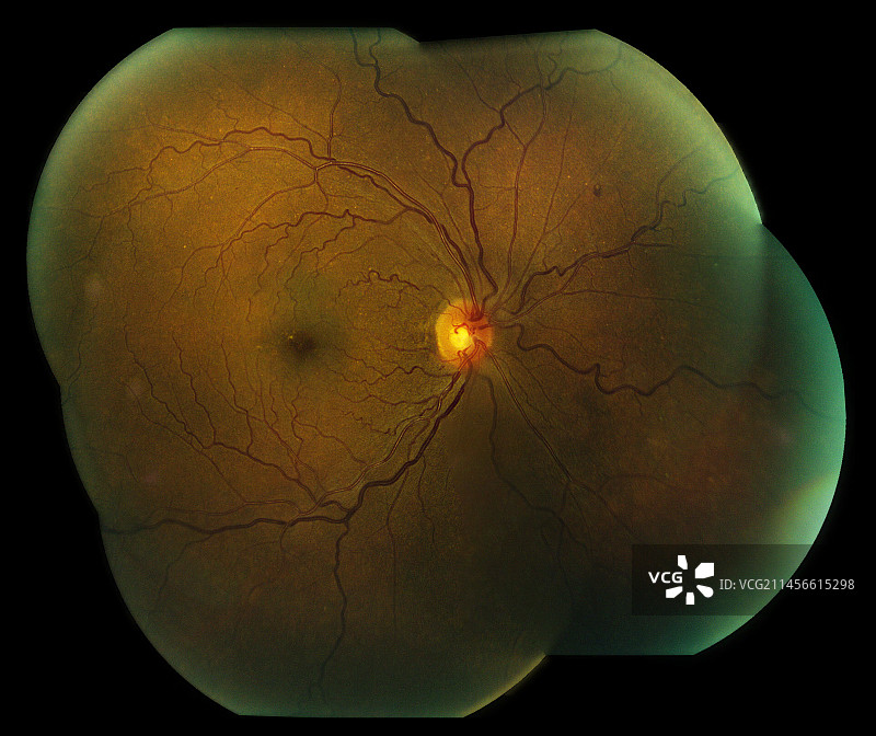 中心视网膜静脉阻塞图片素材