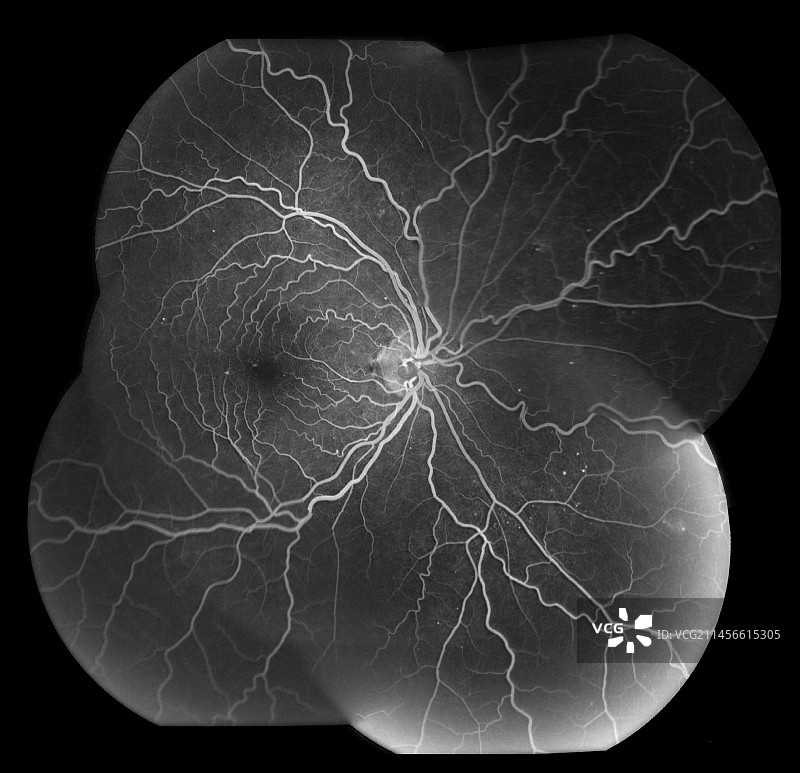 中心视网膜静脉阻塞血管造影图片素材