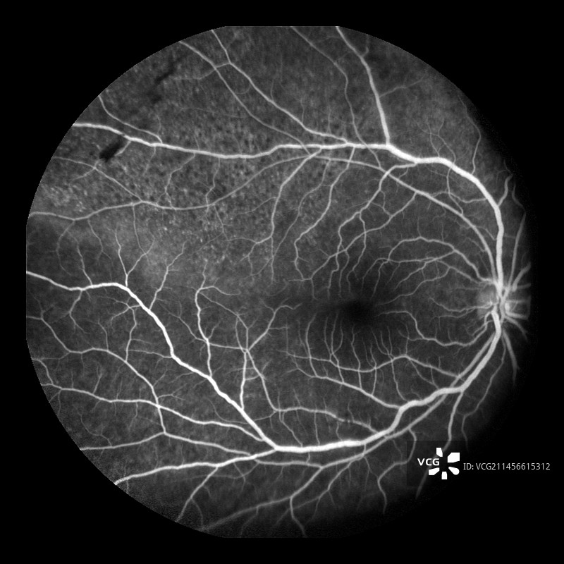 视网膜劈裂血管造影图片素材