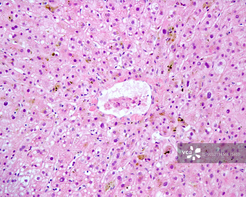 胆汁淤积，光学显微照片图片素材