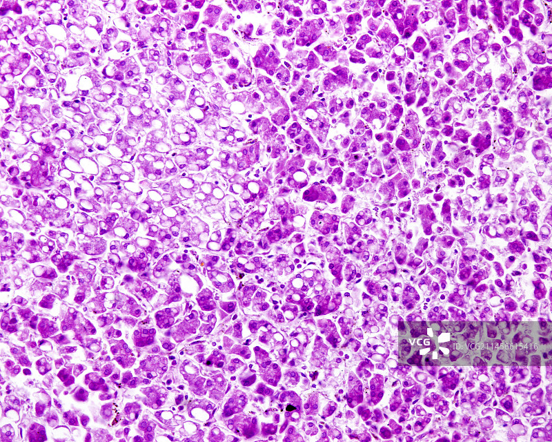 脂肪肝疾病的光学显微照片图片素材