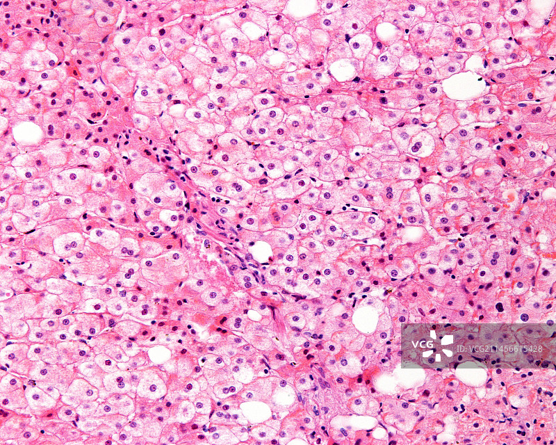 脂肪肝疾病的光学显微照片图片素材