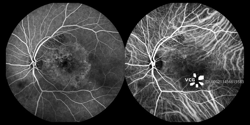 黄斑变性血管造影图片素材