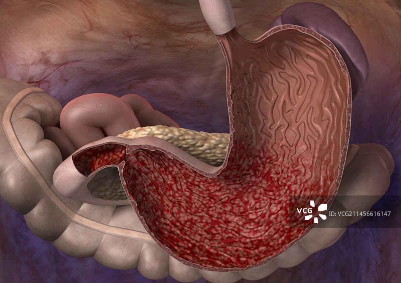 胃部炎症插图图片素材