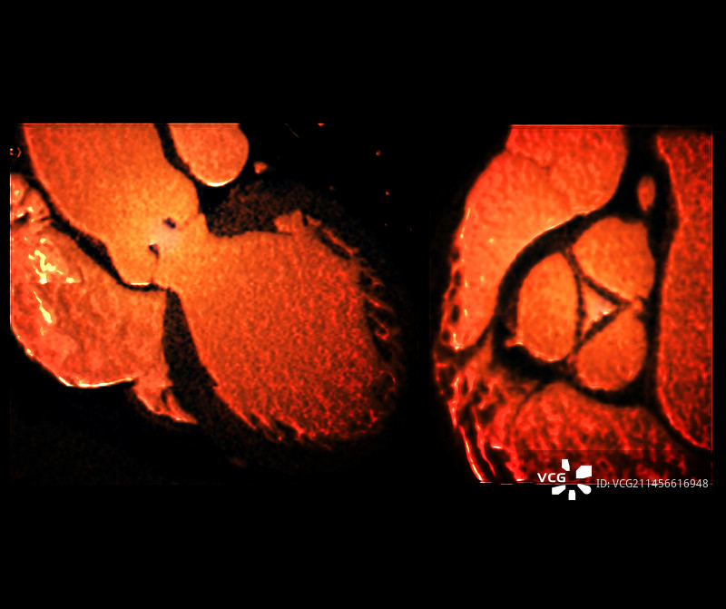 主动脉瓣关闭不全CT血管造影图片素材