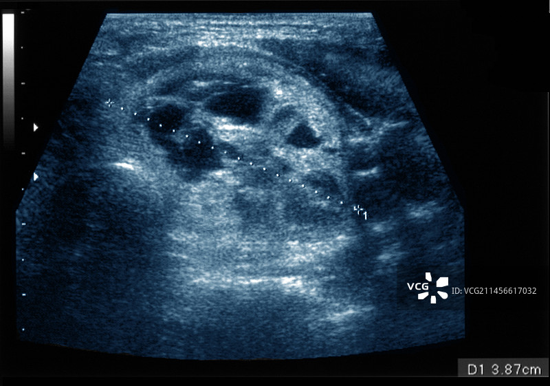 甲状腺结节，超声波扫描图片素材