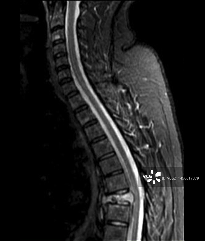 脊髓癌：核磁共振扫描图片素材