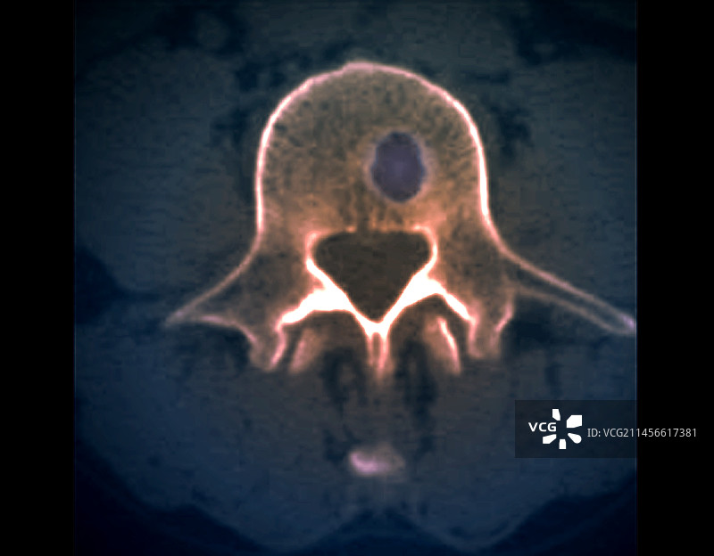 施莫氏结节CT扫描图片素材