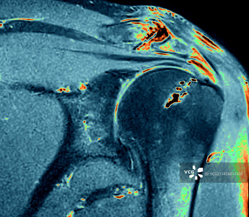 钙化性肌腱炎，MRI扫描图片素材