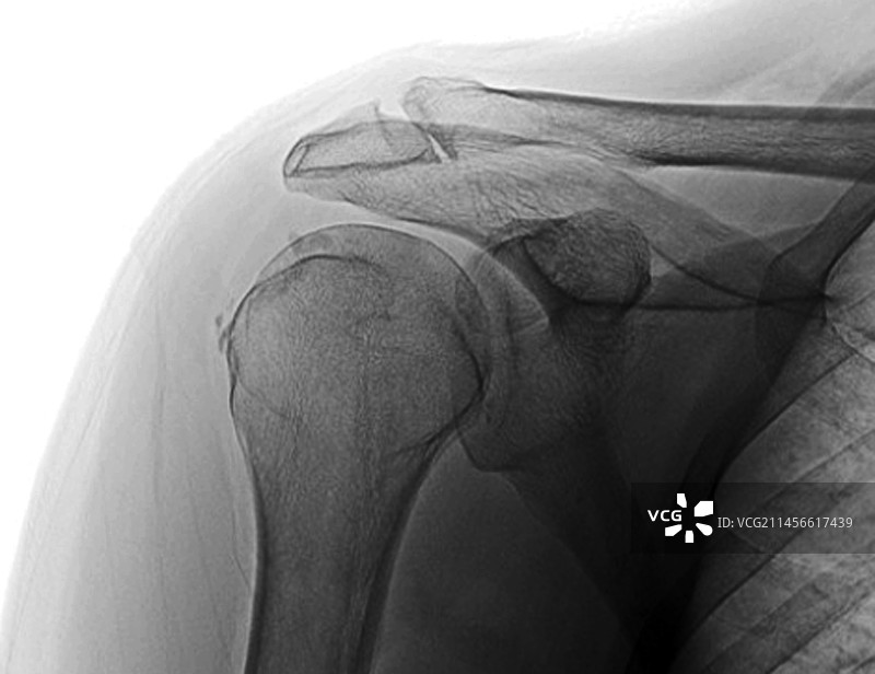 钙化性肌腱炎X光片图片素材
