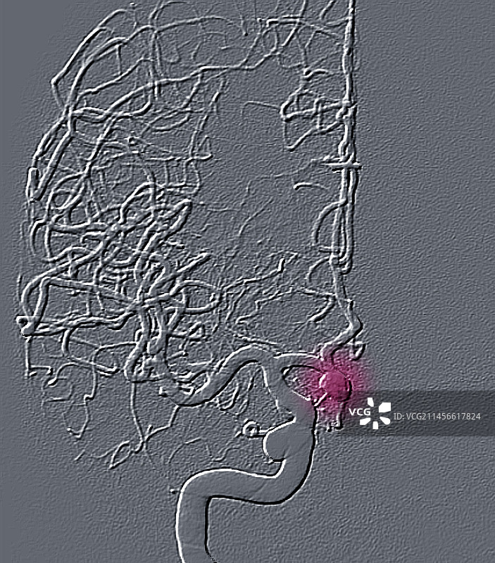 脑动脉瘤血管造影图片素材