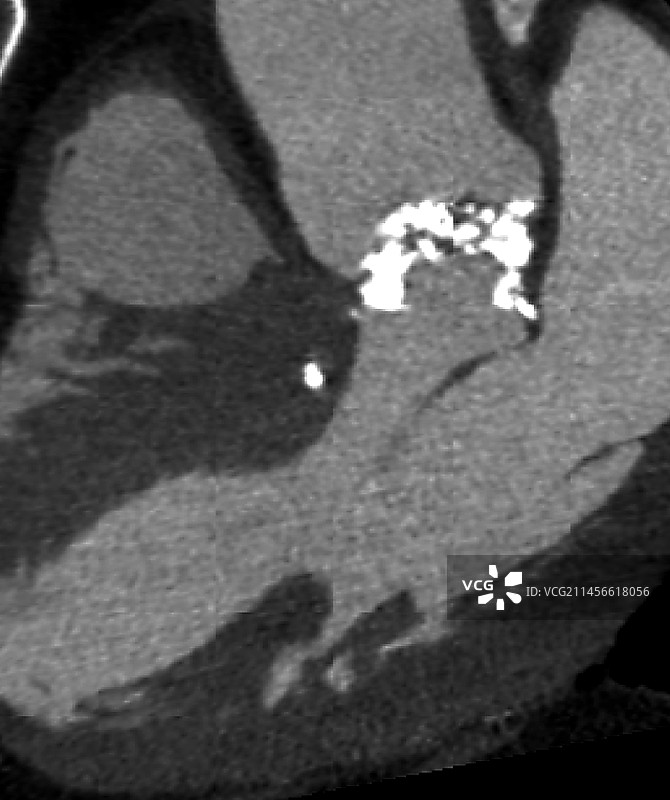 心脏瓣膜疾病CT血管造影图片素材