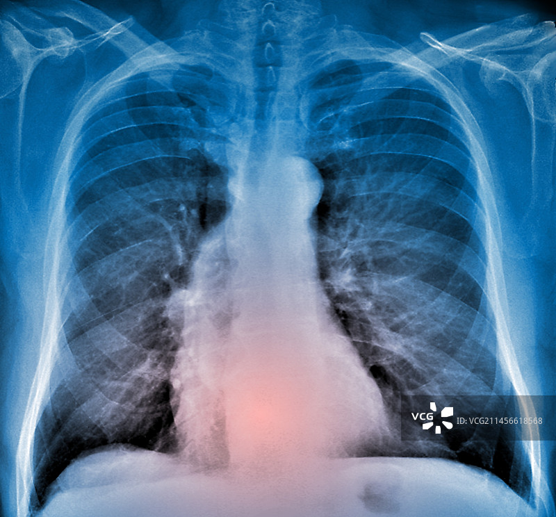 胸主动脉瘤，X光片图片素材