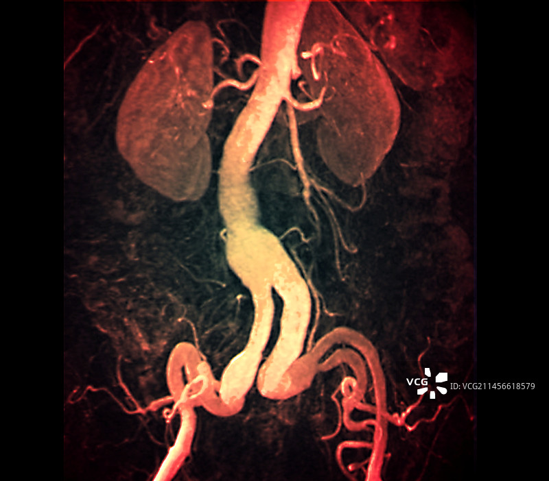 髂动脉和肾动脉动脉瘤核磁共振血管造影图片素材