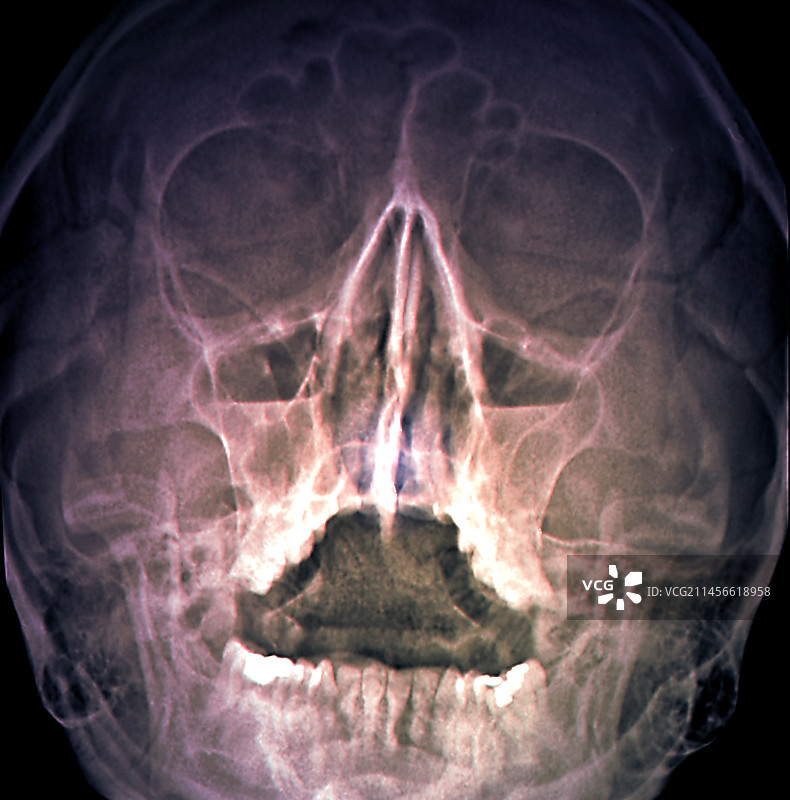 鼻窦炎X光片图片素材
