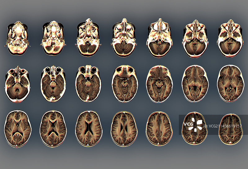 儿童正常大脑的核磁共振扫描图片素材