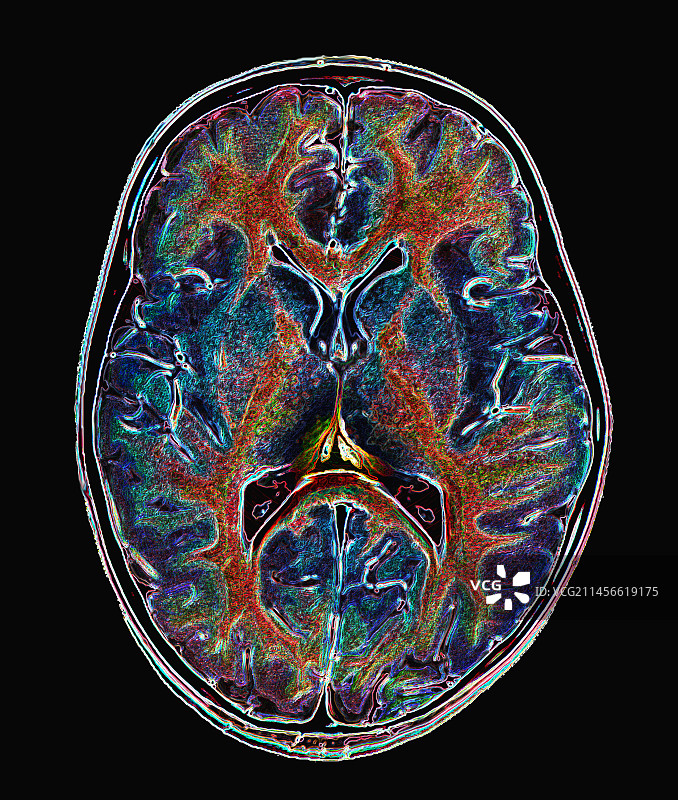 健康的大脑核磁共振扫描图片素材