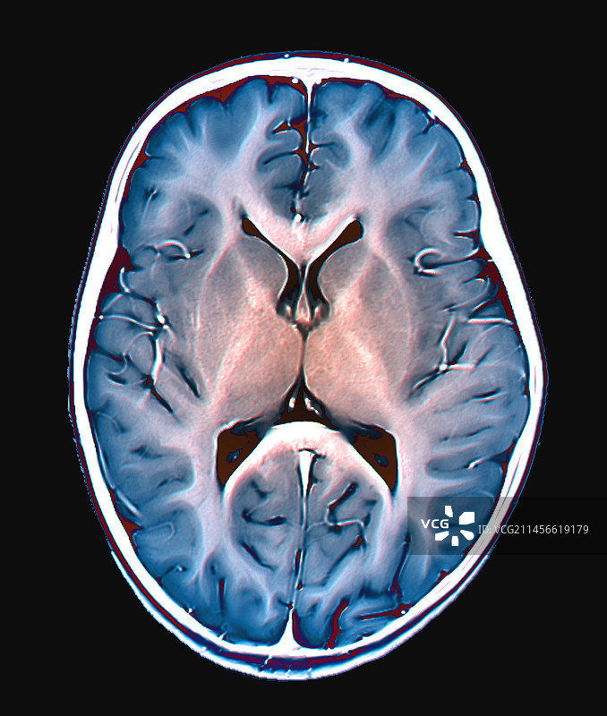 健康的大脑核磁共振扫描图片素材