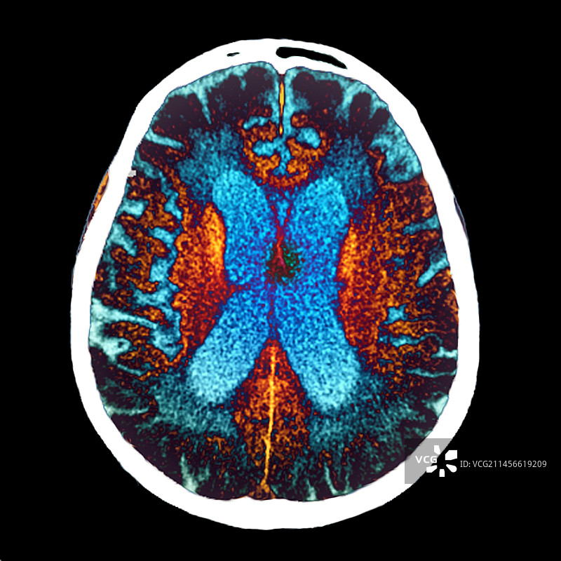老年痴呆症CT扫描图片素材