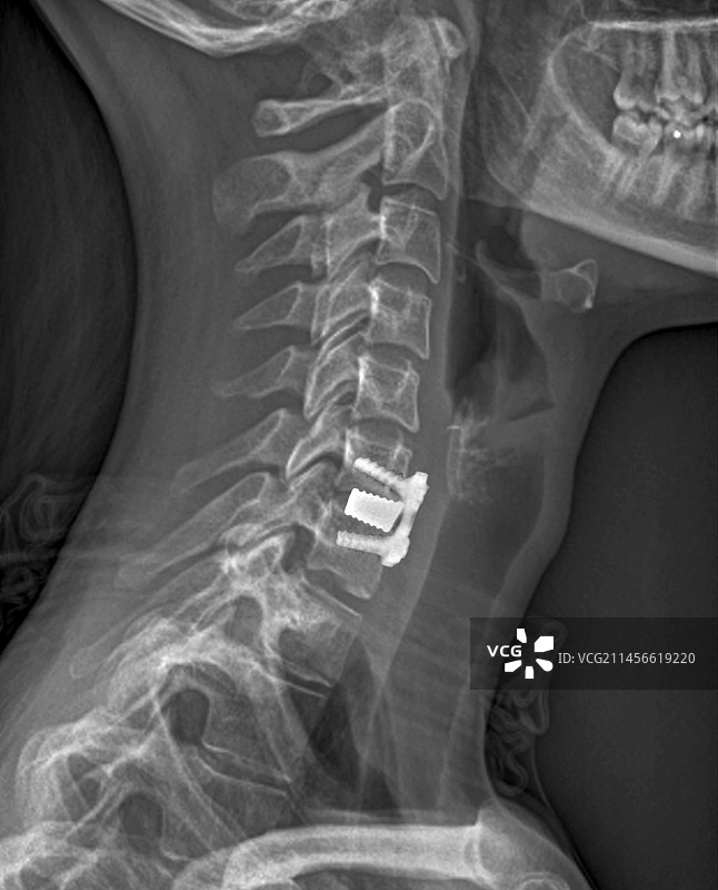 脊椎间盘突出治疗X光片图片素材