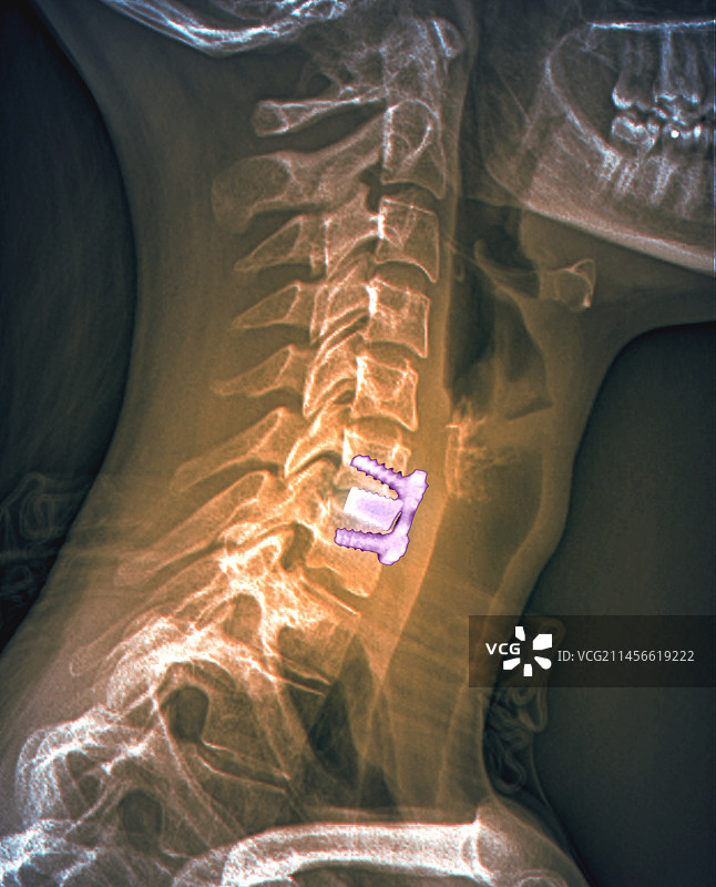 脊椎间盘突出治疗X光片图片素材