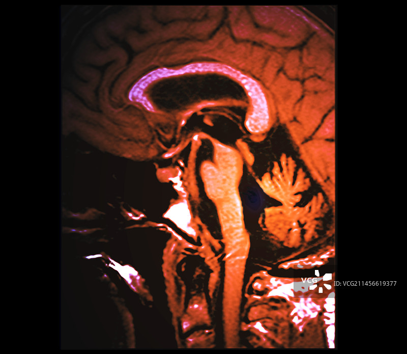 进行性核上性麻痹，MRI扫描图片素材