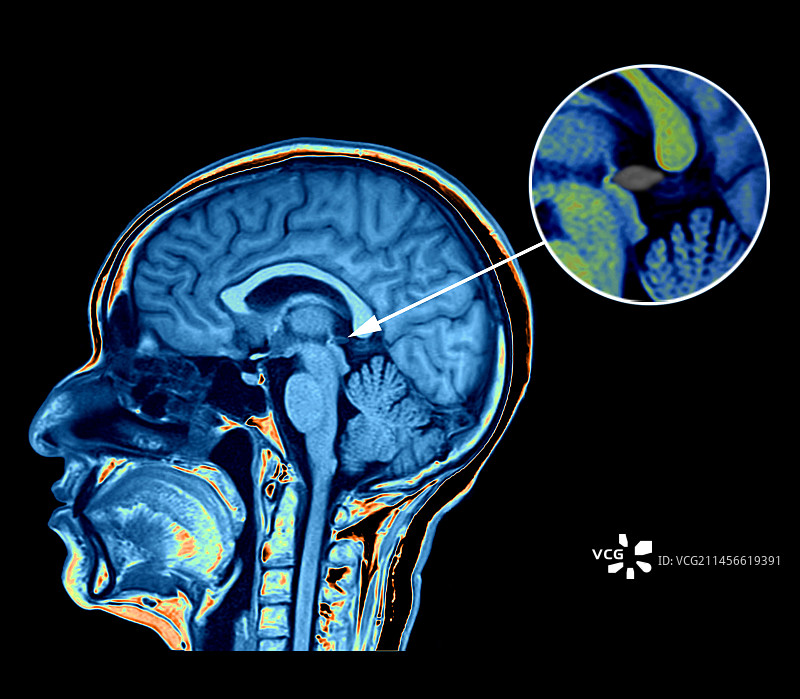 健康的松果体核磁共振扫描图片素材