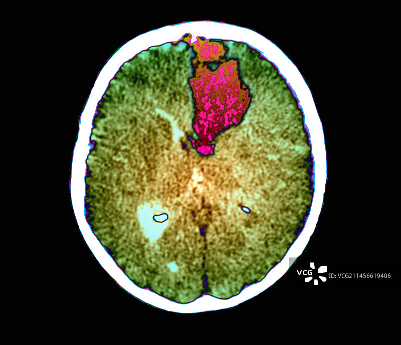 脑出血CT扫描图片素材