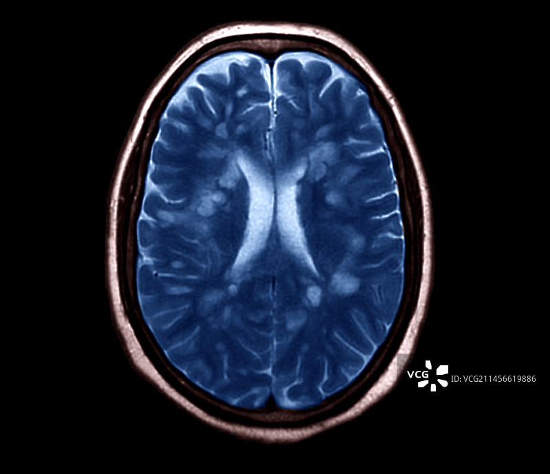多发性硬化症MRI扫描图片素材