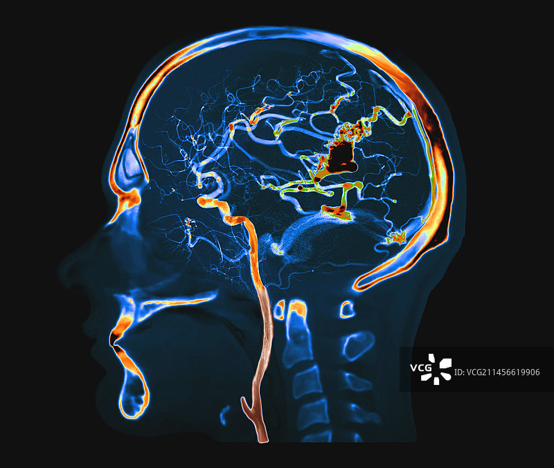 动静脉畸形CT血管造影图片素材