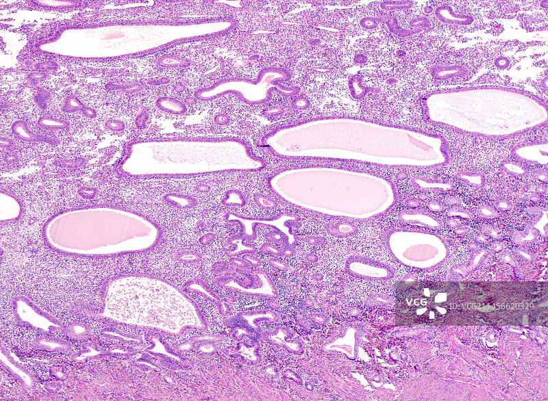 非典型子宫内膜增生，光学显微照片图片素材