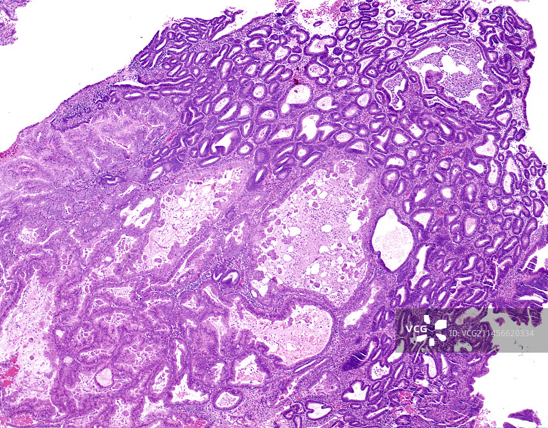 非典型子宫内膜增生，光学显微照片图片素材