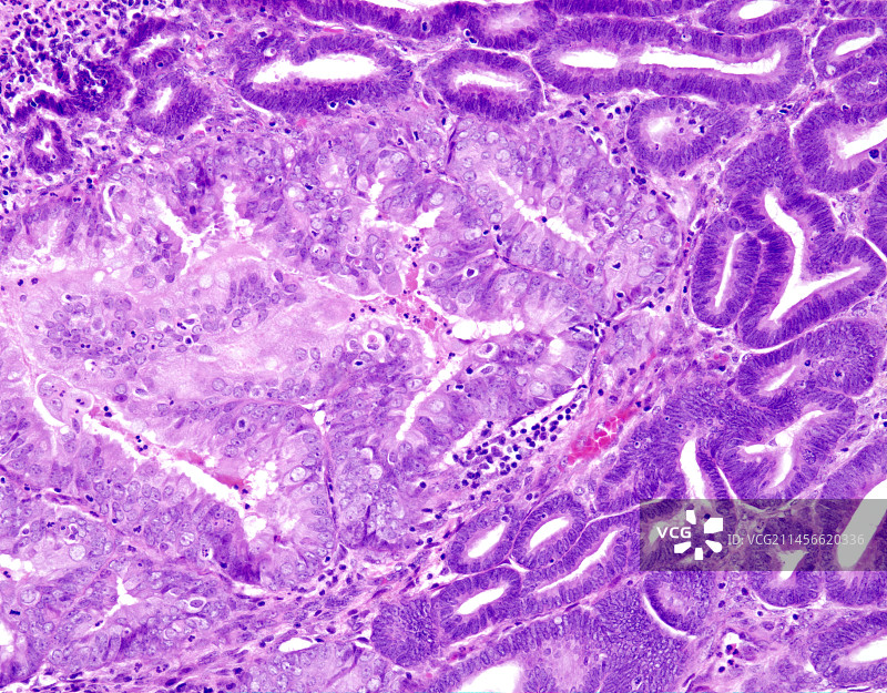 非典型子宫内膜增生，光学显微照片图片素材
