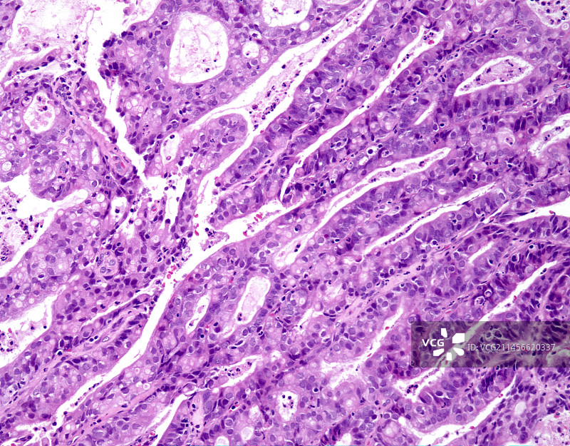 子宫内膜样癌1级光学显微照片图片素材
