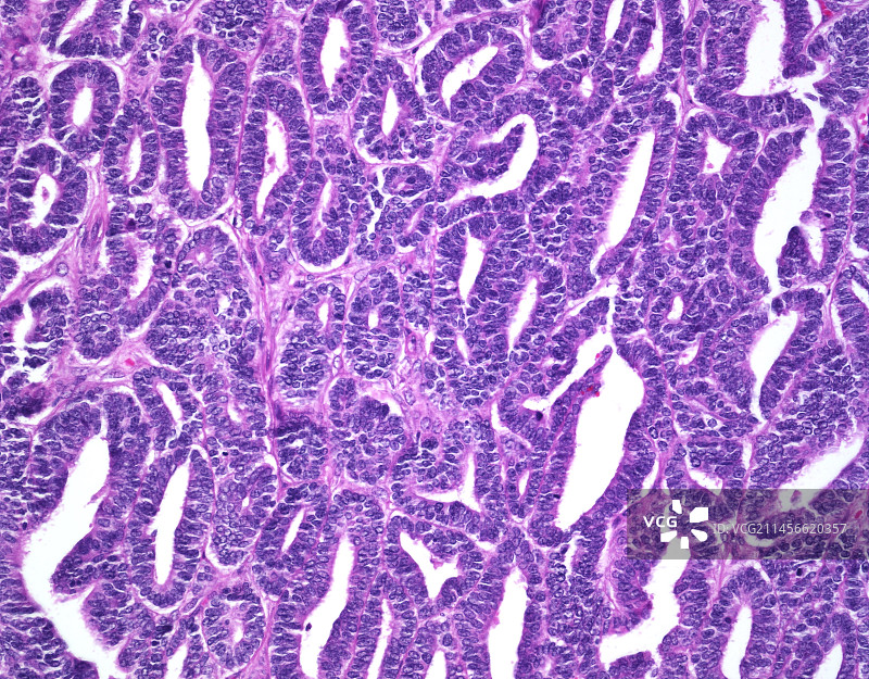 子宫内膜样癌1级光学显微照片图片素材