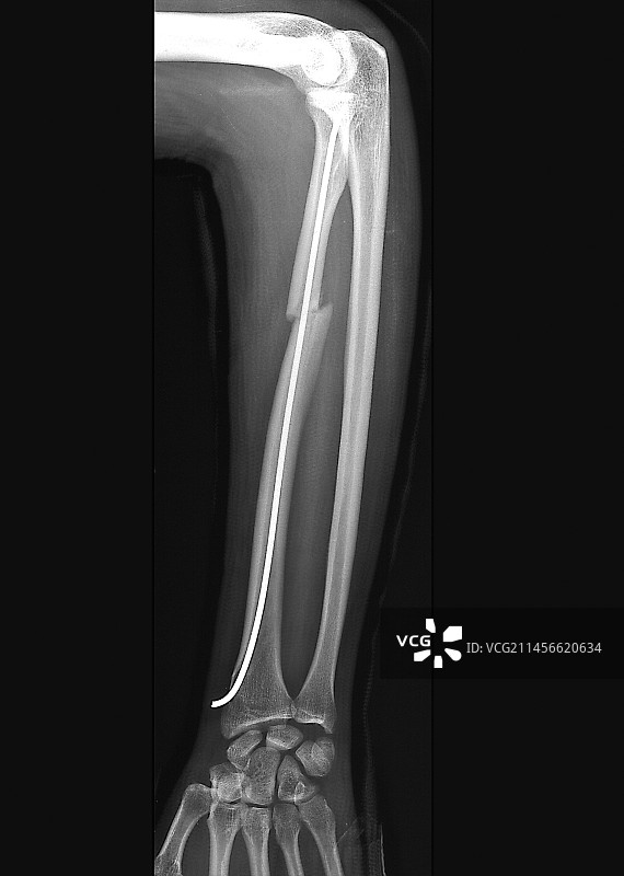 桡骨骨折X光片图片素材