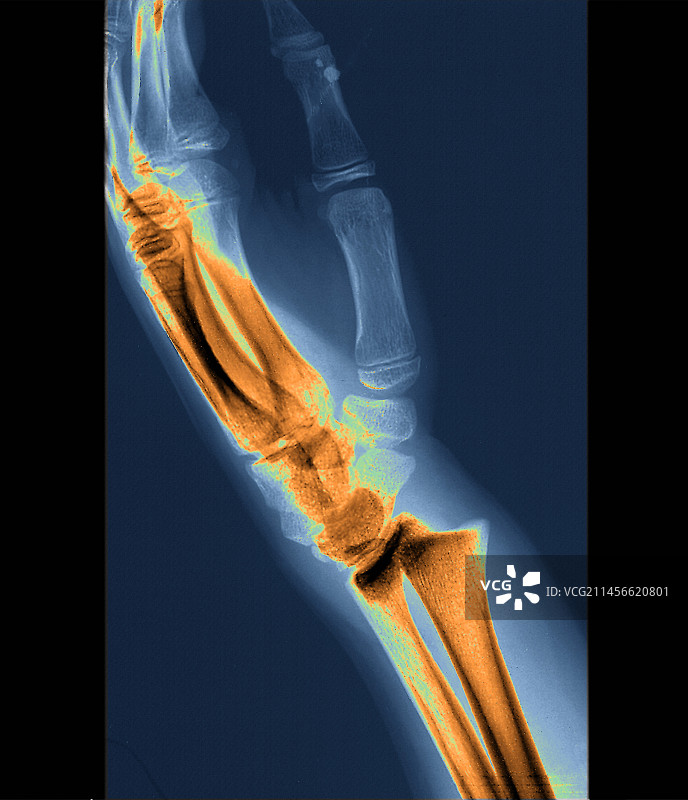 手腕骨折X光片图片素材