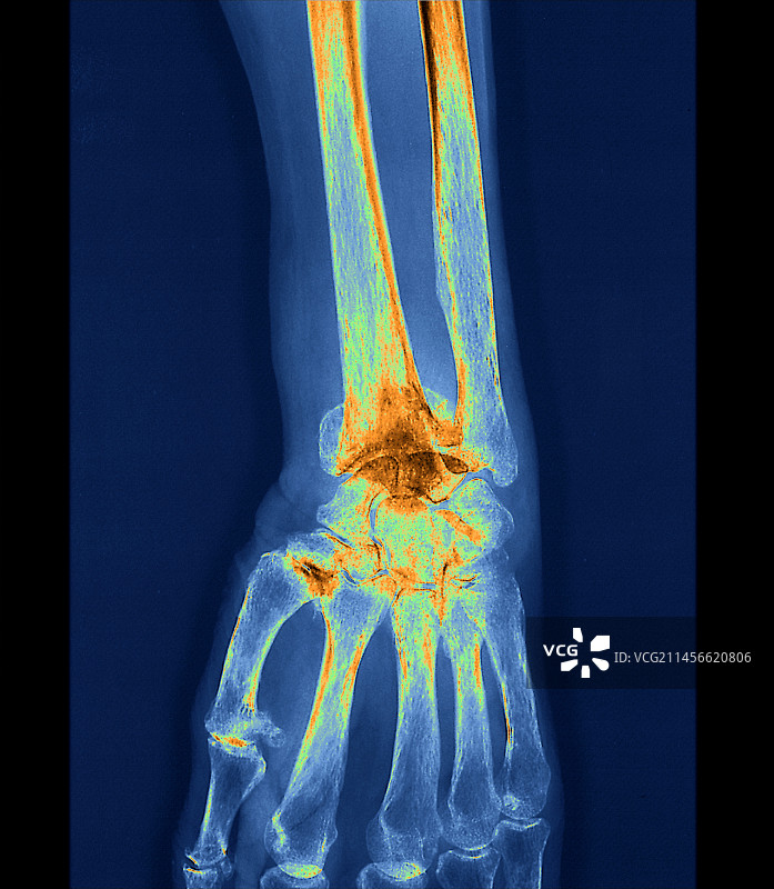 左手腕骨折X光片图片素材