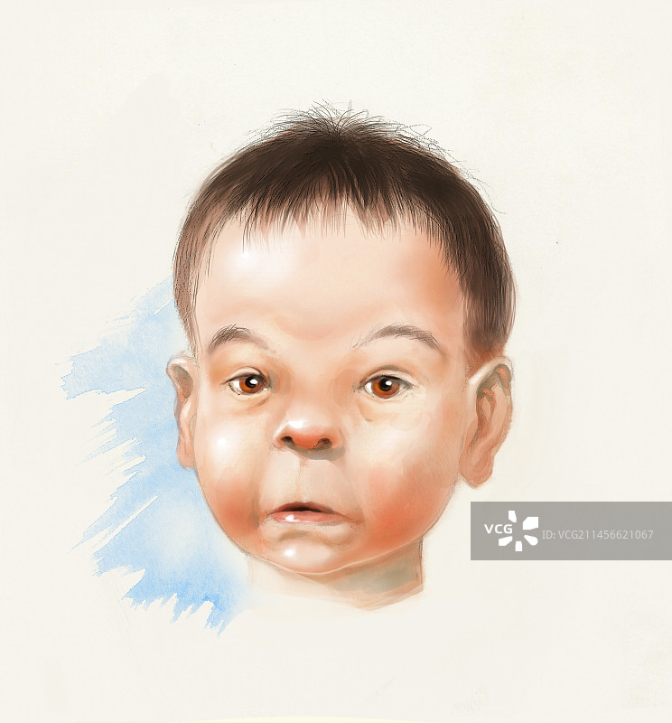 胎儿酒精综合征婴儿插画图片素材