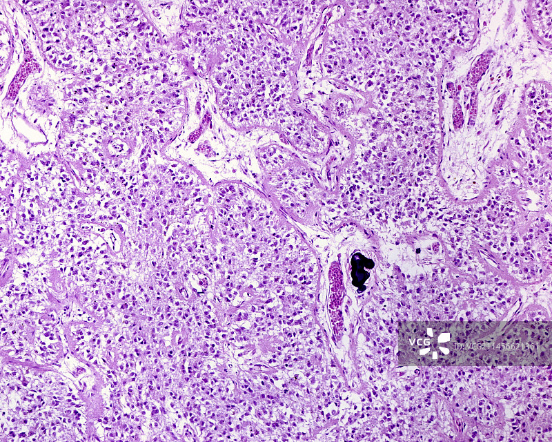 人松果体中的钙化结石，光学显微照片图片素材