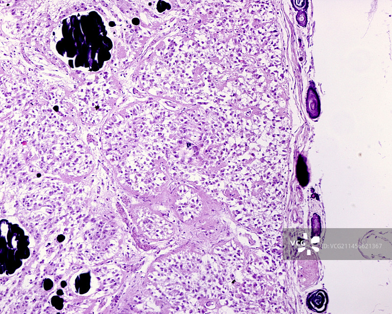 人松果体中的钙化结石，光学显微照片图片素材