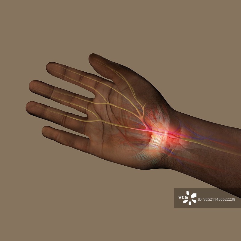腕管综合征插图图片素材