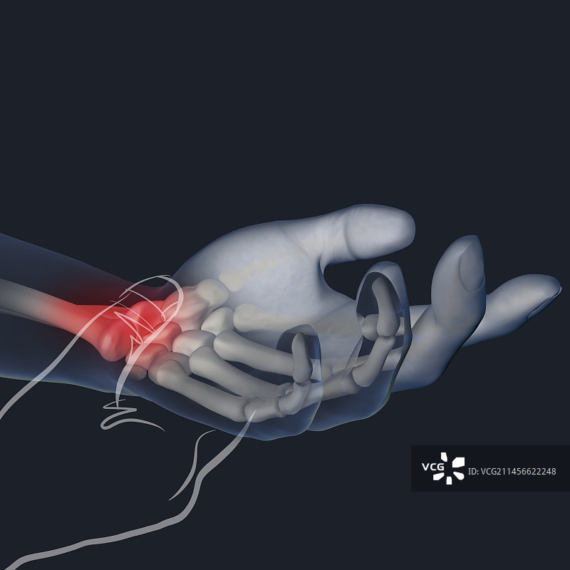 腕管综合征插图图片素材