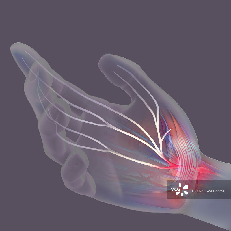 腕管综合征插图图片素材